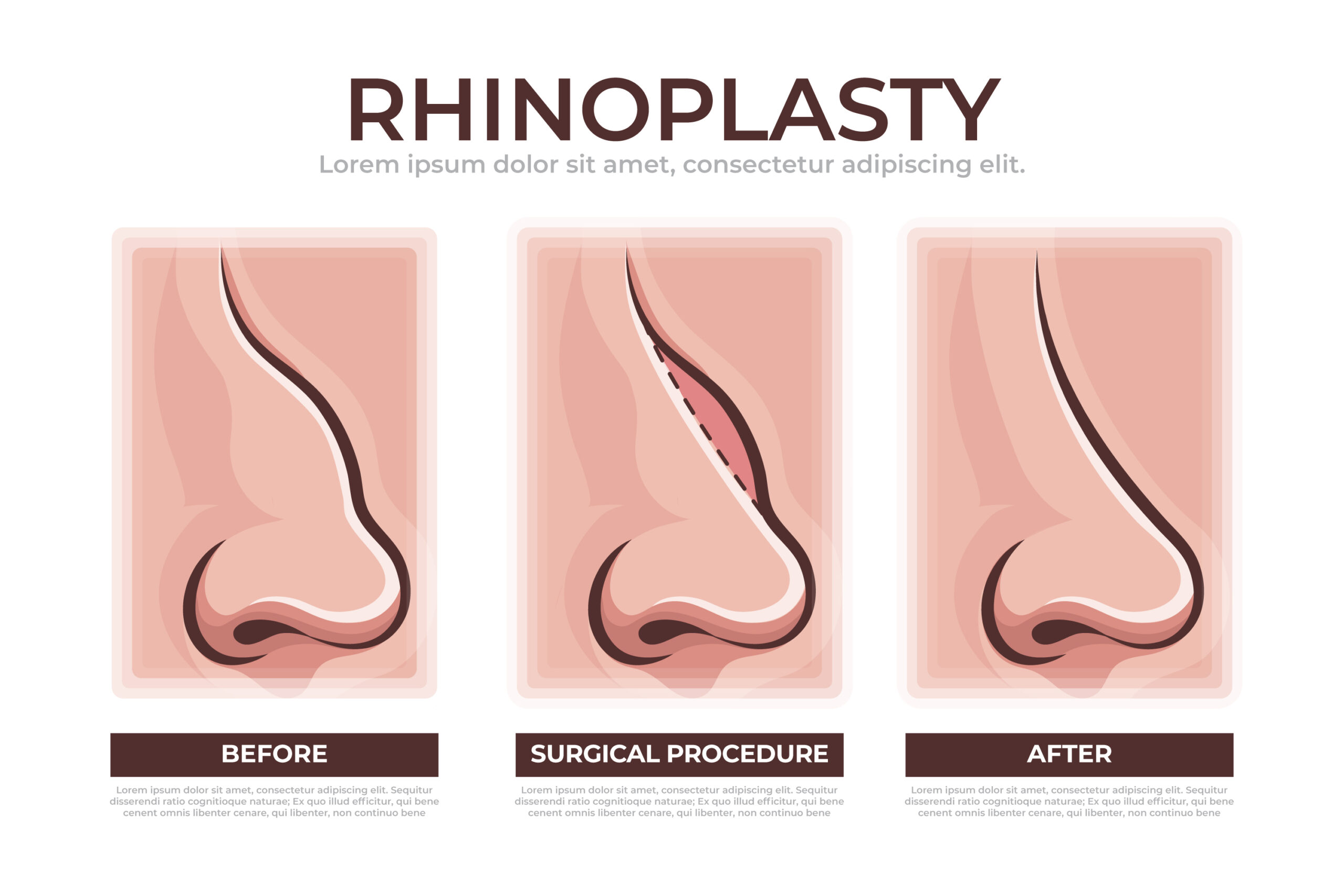 rinoplastia precio madrid