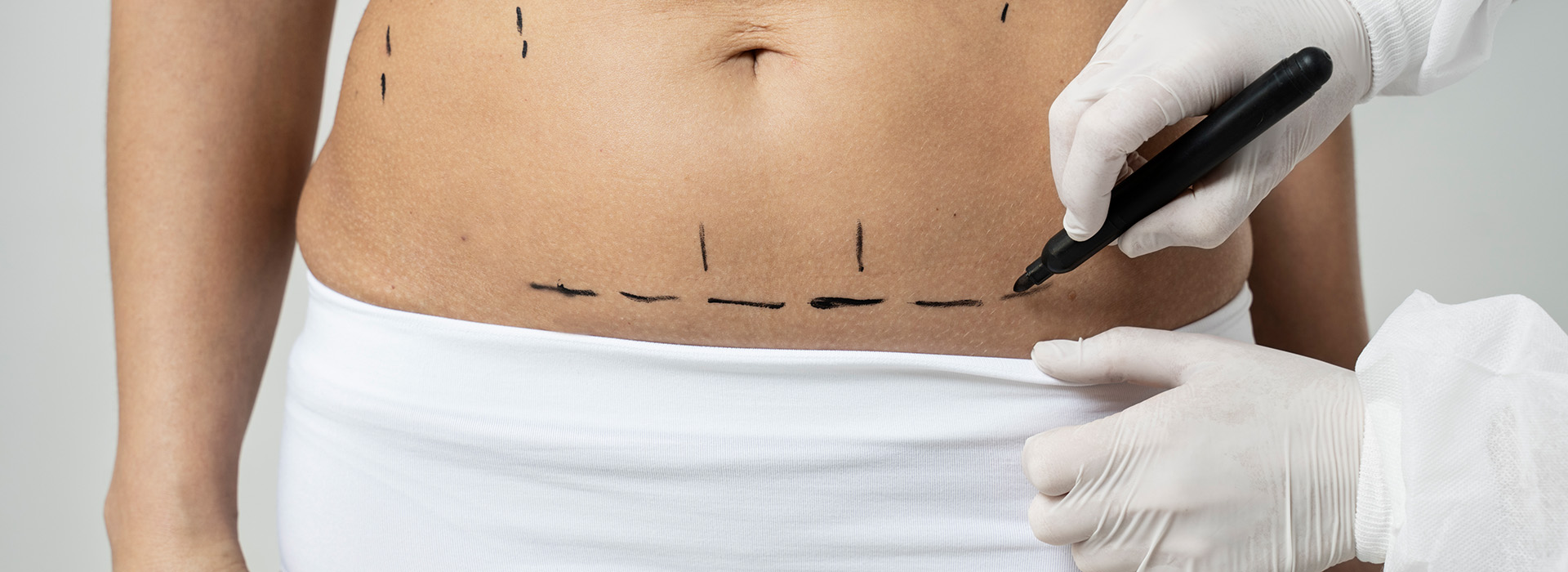 abdominoplastia