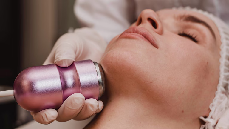 Microneedling con Radiofrecuencia