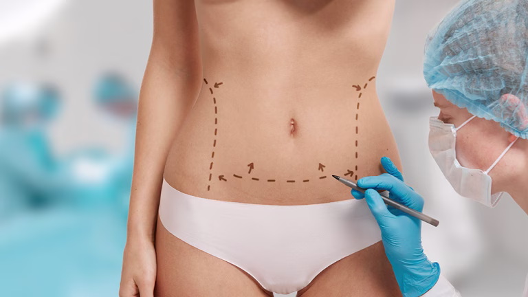 Cuánto tiempo tarda la recuperación de una abdominoplastia